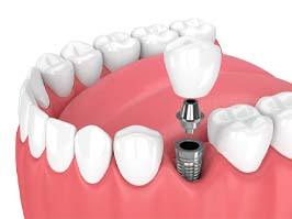 A digital image of a single tooth dental implant and all its parts in Carmichael