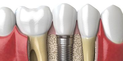 Illustration of dental implant in jaw with healthy bone tissue