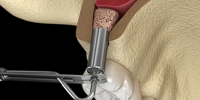 Illustration of adding new bone during sinus lifting procedure