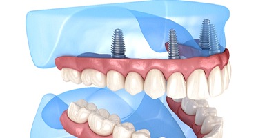 Illustration of All-on-4 for top and bottom arches