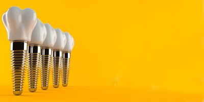 dental implants and crowns