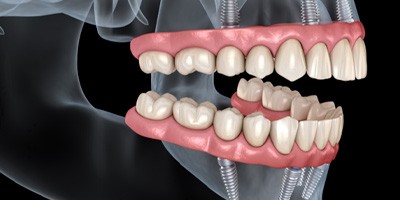 Illustration of All-on-4 dental implants for top and bottom dental arches