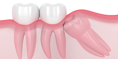 Illustration of a tooth impacted and pressing against other teeth