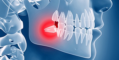 Illustration of X-ray of Impacted Wisdom Tooth