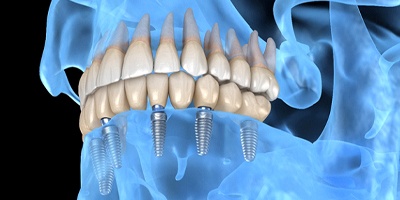 Dental implants in jaw