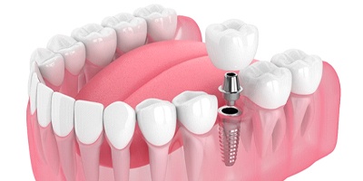 Dental implant, abutment, crown