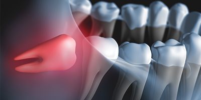 Animation of impacted wisdom tooth