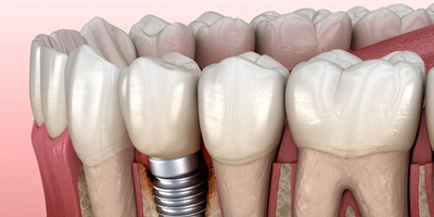 Illustration of peri-implantitis, a common cause of dental implant failure