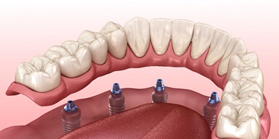 Illustration of full implant denture for lower arch