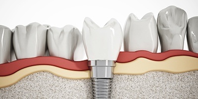 diagram of dental implants in Carmichael