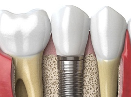 Diagram of bone grafting in Carmichael