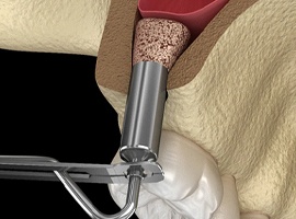 diagram of sinus lift in Carmichael