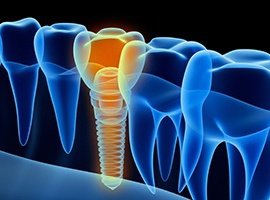 diagram for how dental implants work in Carmichael