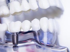 Closeup of dental implants in Carmichael model