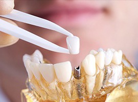 Carmichael implant dentist holding final restoration