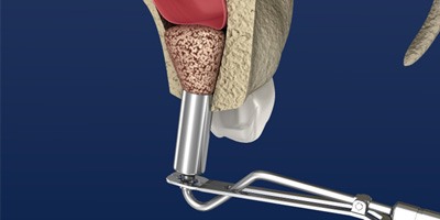 Illustration of a sinus lift in Carmichael, CA