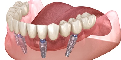 Dental Implants