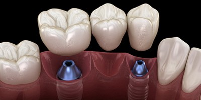 Implant-retained bridge