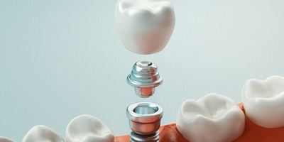 Illustration of implant, abutment, and restoration being placed in mouth