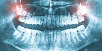 X-Ray showing impacted wisdom teeth in upper jaw