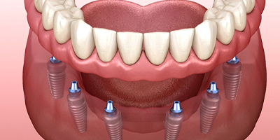 Illustration of implant dentures; full dentures and six implant posts