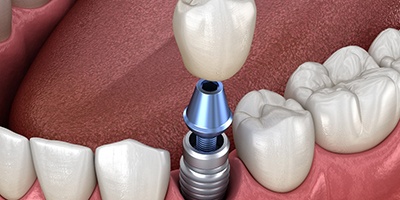 Implant and crown