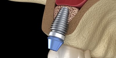 Illustration of a dental implant placed after a sinus lift 