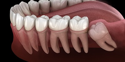 Digital Illustration of impacted wisdom tooth