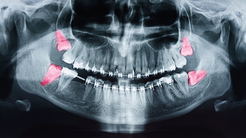 digital x-ray of wisdom teeth