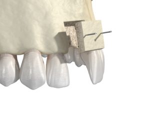 Illustration of dental bone graft being placed in upper jaw