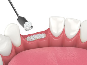 Illustration of a bone graft after two teeth have been extracted