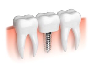 CGI illustration of a dental implant between 2 other teeth